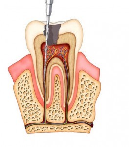 endodoncia