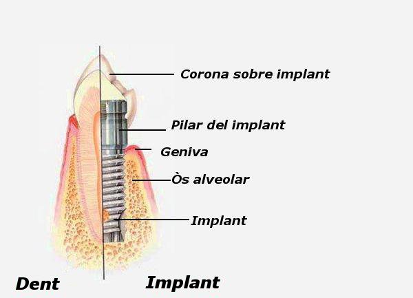 implant