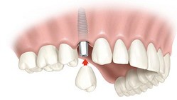 protesi dental